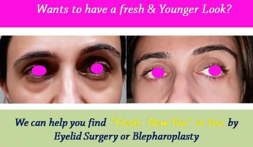 blepharoplasty-eyelid-nose-surgery-surat-valsad-navsari-bharuch-vapi-usa-2