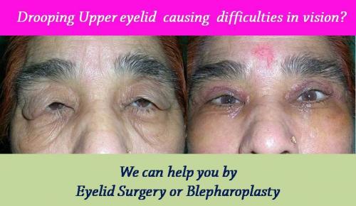 blepharoplasty-eyelid-nose-surgery-surat-valsad-navsari-bharuch-vapi-vadodara-uk-usa-012