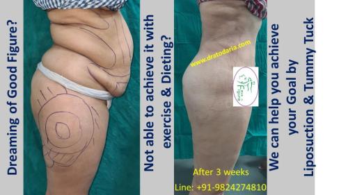 Best-liposuction-surat-gujarat-india-clinic-doctor-1