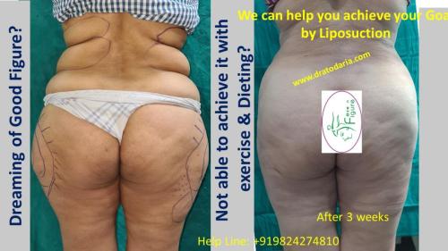 Best-liposuction-surat-gujarat-india-clinic-doctor-surgeon-1