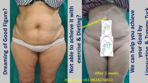 Best-liposuction-surat-gujarat-india-clinic-doctor