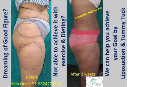 Body-contouring-liposuction-vaser-laser-tummy-tuck-surat-gujarat-usa-canada-uk-1