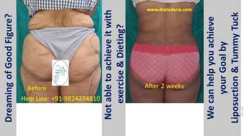 Body-contouring-liposuction-vaser-laser-tummy-tuck-surat-gujarat-usa-canada-uk-2