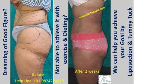 Body-contouring-liposuction-vaser-laser-tummy-tuck-surat-gujarat-usa-canada-uk-3